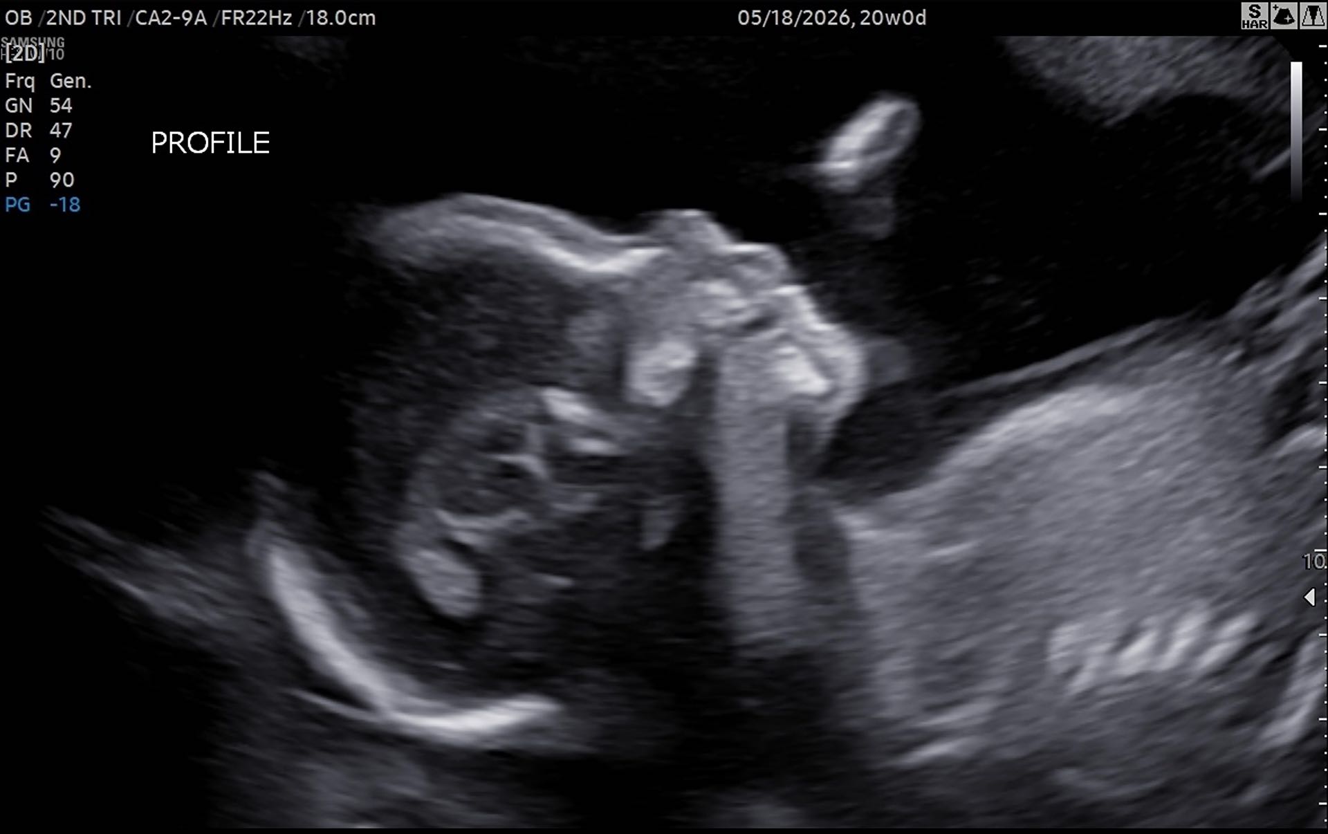 The big "Anatomy Scan" from early January for our baby at 20 weeks. This was a moment where we started to find some relief from anxiety!