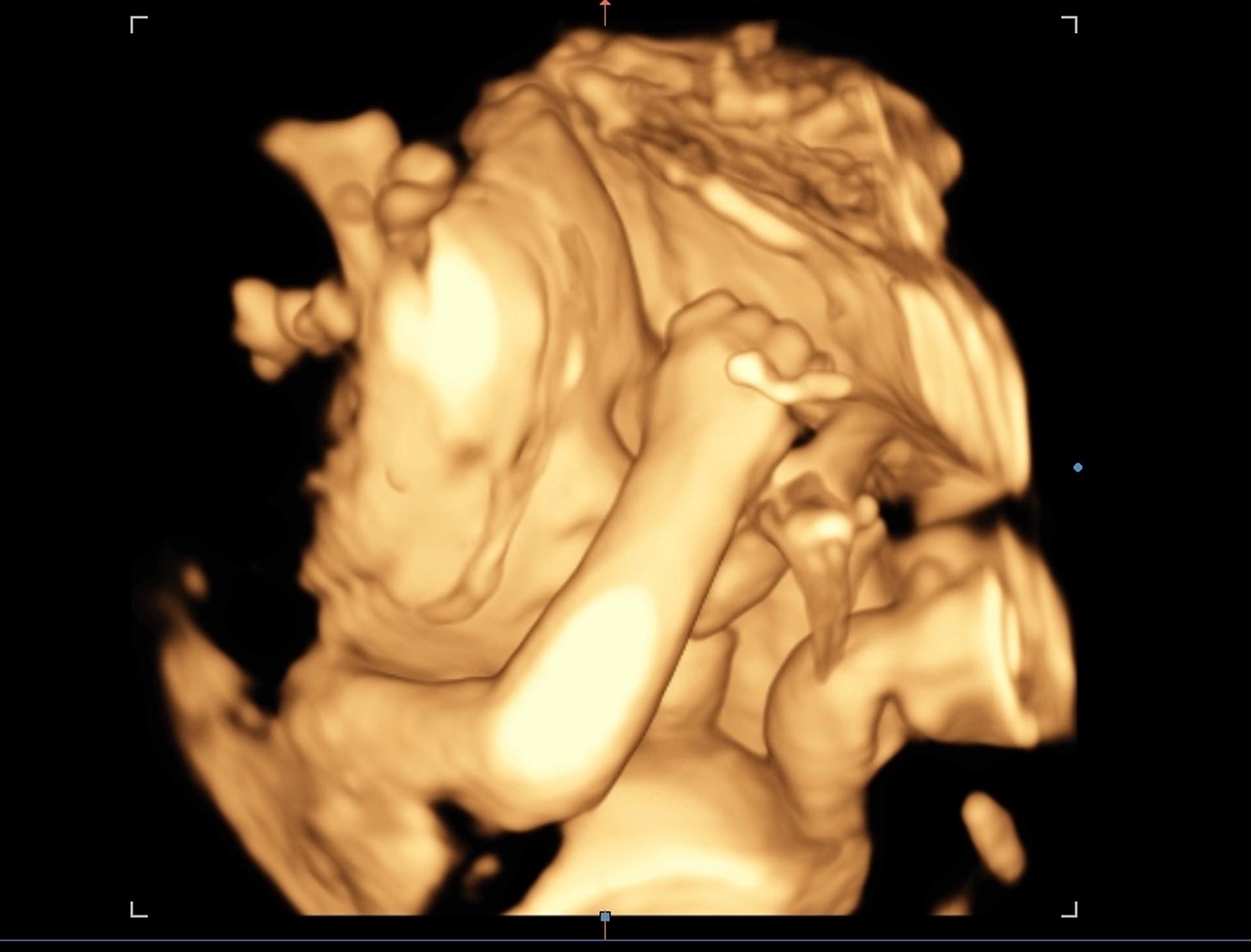 We know you all love our ongoing baby updates! ;-) Here's a fun 3D rendering from a recent ultrasound. He or she has got that arm guard ready!