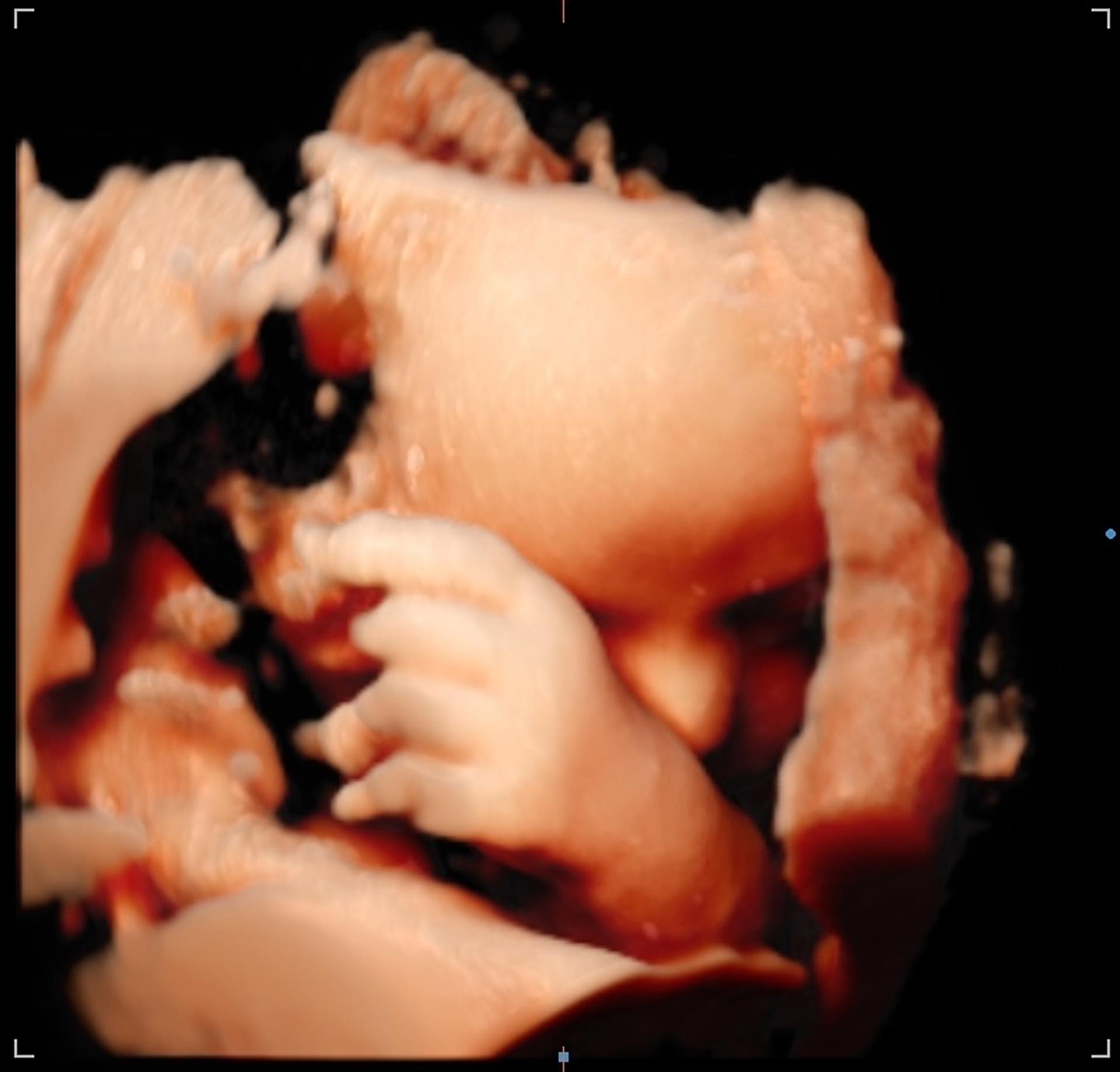 The 3D render from our latest ultrasound of little baby TicTocLife.